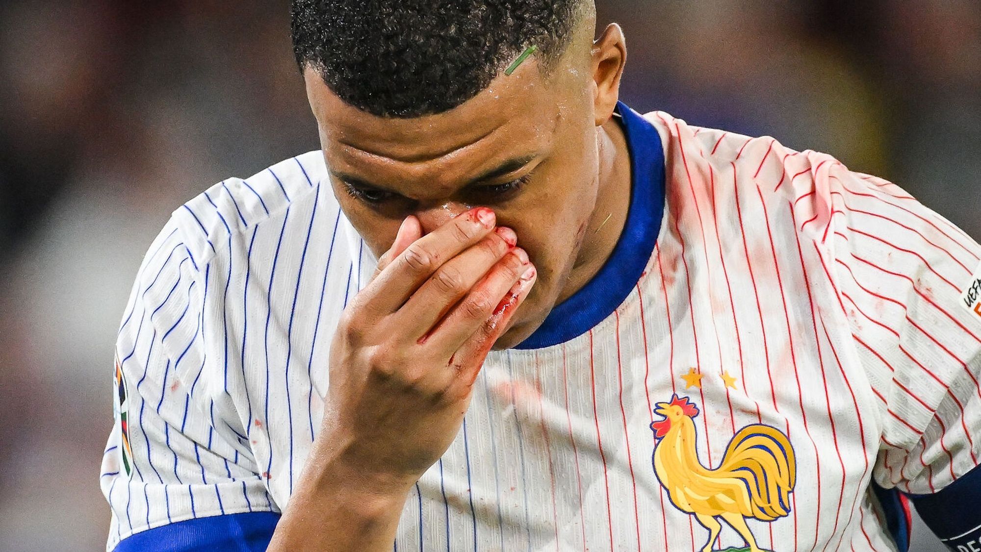 Mbappé habla sobre su fractura nasal y anuncia lo que ha pactado con los médicos